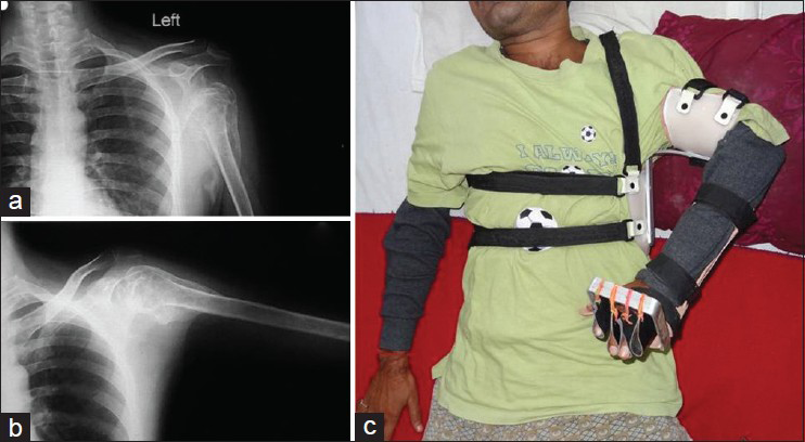 X-ray of the left shoulder in PA view in adducted (a) and abducted (b) Position showing heterotopic ossification, With left abduction orthosis with left dynamic cock-up splint (c)